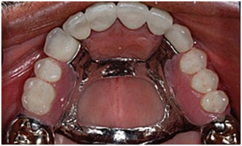 Partial Dentures